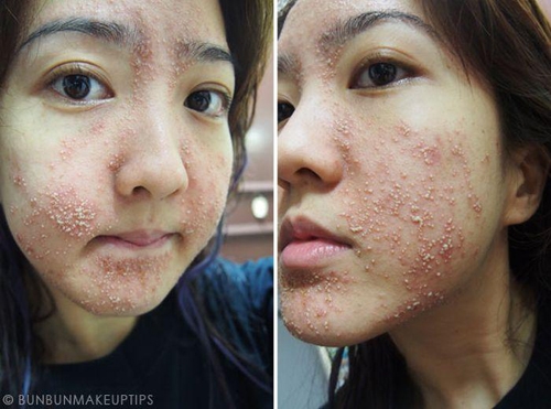 Một blogger người Singapore đã gây shock khi chia sẻ khuôn mặt sần sùi mụn bọc tới "kinh hoàng" của mình sau khi lột da.
